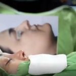 از بین بردن قوز بینی در قزوین
