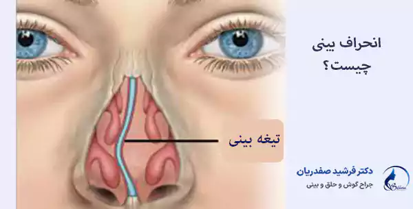 انحراف بینی چیست