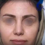 بازگشت به کار بعد از عمل بینی