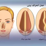 عمل انحراف بینی