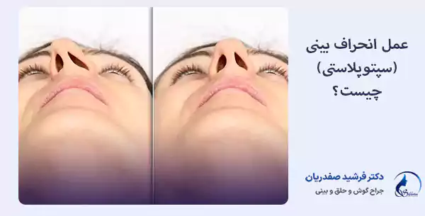عمل انحراف بینی (سپتوپلاستی) چیست؟