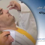 عمل بینی مردانه