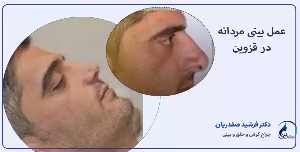 عمل بینی مردانه در قزوین