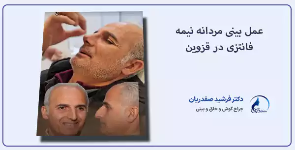 عمل بینی مردانه نیمه فانتزی در قزوین