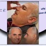عمل بینی در افراد مسن