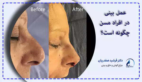 عمل بینی در افراد مسن چگونه است؟