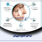 اقدامات قبل از عمل بینی