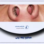 درمان هماتوم بینی در قزوین