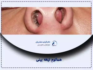 درمان هماتوم بینی در قزوین