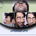 سپتورینوپلاستی