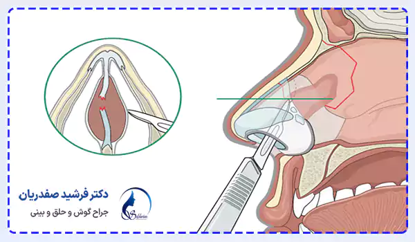 علائم هماتوم تیغه بینی