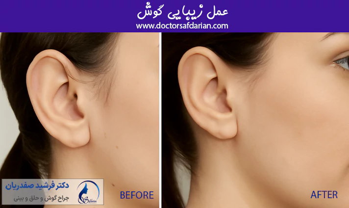 عمل زیبایی گوش