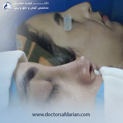 جراحی بینی طبیعی