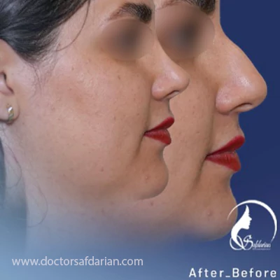نمونه کار قبل و بعد عمل بینی